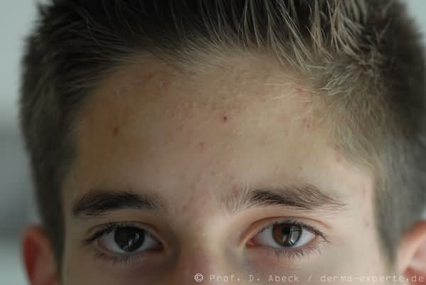 Acne comedonica. Zahlreiche, überwiegend geschlossene (weiße) Komedonen im Stirnbereich. Nur einzelne entzündliche Läsionen.