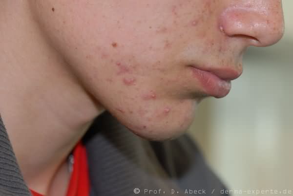 Acne papulopustulosa. Acne papulopustulosa. Entzündliche Knötchen, teilweise mit zentraler Pusteln neben Komedonen.