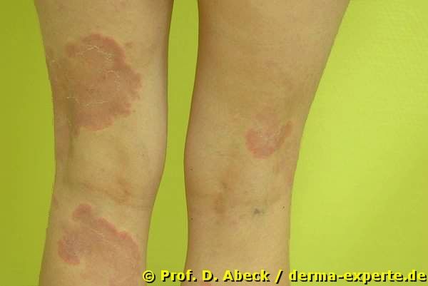 Erythema anulare centrifigum