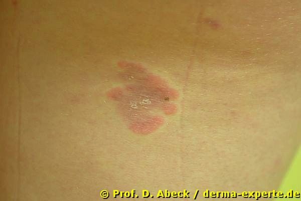 Erythema anulare centrifigum