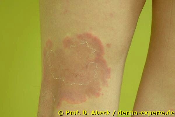 Erythema anulare centrifigum