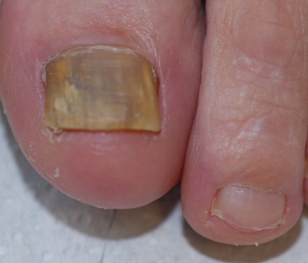 Nagelpilz Nagelmykose