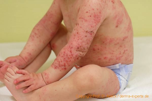Abbildung 3. Atopisches Ekzem. Schweres atopisches Ekzem des Säuglingsalters. Am ganzen Körper finden sich infiltrierte schuppende Rötungen, die zerkratzt sind und teilweise von Schuppenkrusten bedeckt sind. Abbildung 3. Atopisches Ekzem. Schweres atopisches Ekzem des Säuglingsalters. Am ganzen Körper finden sich infiltrierte schuppende Rötungen, die zerkratzt sind und teilweise von Schuppenkrusten bedeckt sind.