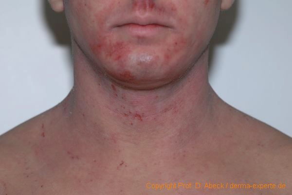 Abbildung 4. Atopisches Ekzem. Schweres atopisches Ekzem im Erwachsenenalter. Flächige Erytheme mit nässenden Hautveränderungen im Kinn und am Hals Abbildung 4. Atopisches Ekzem. Schweres atopisches Ekzem im Erwachsenenalter. Flächige Erytheme mit nässenden Hautveränderungen im Kinn und am Hals