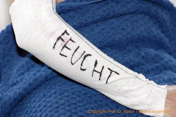 1. Verbandslage: feucht 1. Verbandslage: feucht