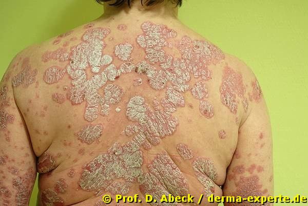 Psoriasis vulgaris vom chronisch stationären Typ