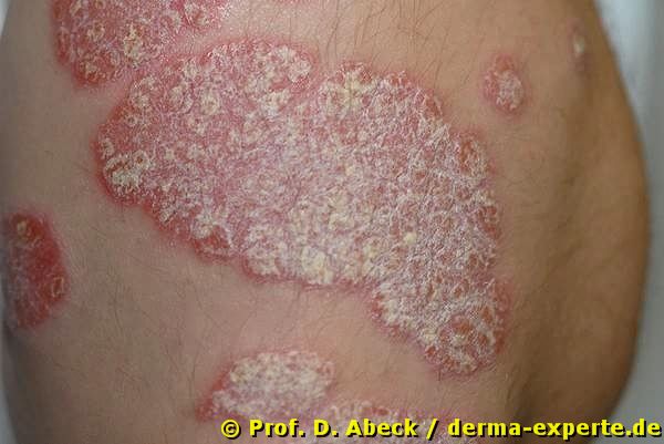 Psoriasis vulgaris vom chronisch stationären Typ