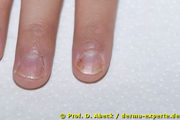 Psoriasis unguium