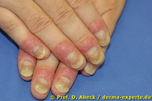 Psoriasis unguium