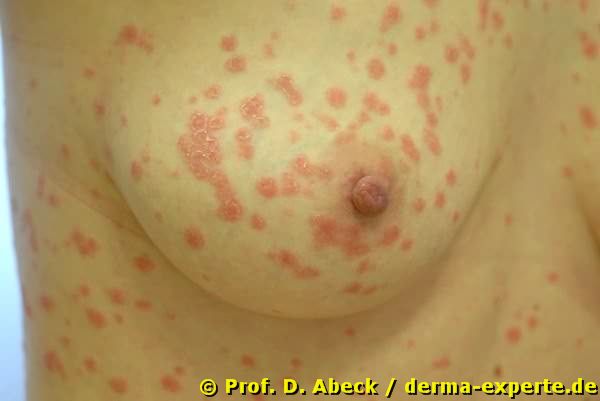 Psoriasis exanthematica