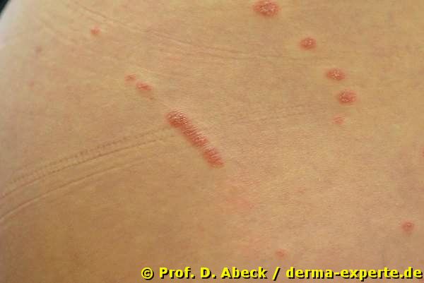 Psoriasis exanthematica