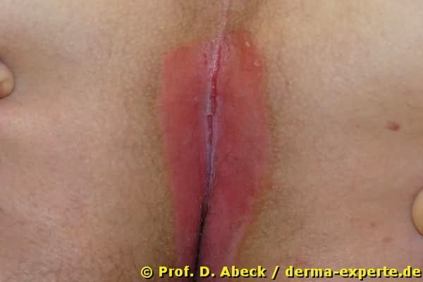Psoriais vulgaris. Anal
