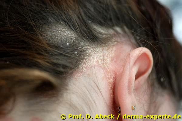 Psoriasis vulgaris. Kopfhautbefall