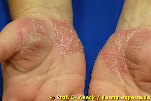 Psoriasis palmaris