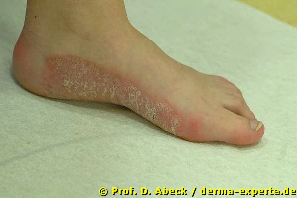 Psoraisis plantaris