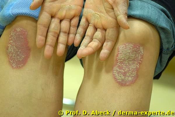 Psoriasis vulgaris